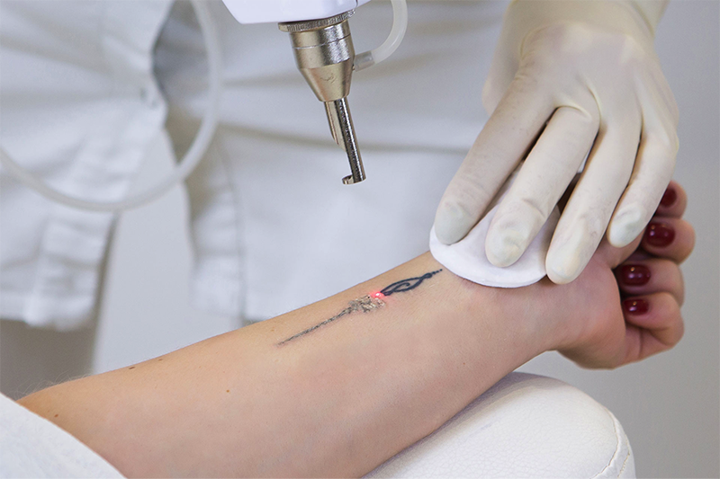 tatoeage-verwijderen-afb