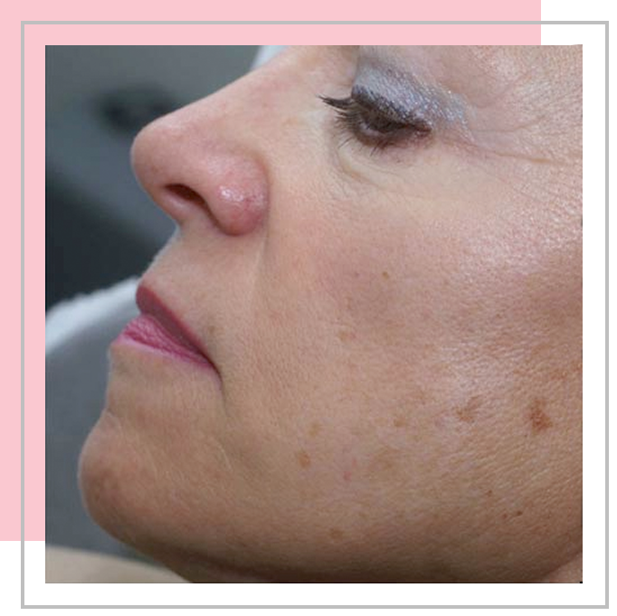 Pearl Laserbehandeling | Health Beauty Center Monique Gottmer