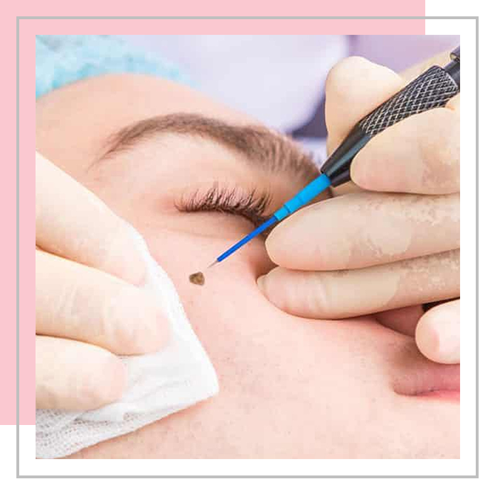 Kader banner monique gottmer derma pen