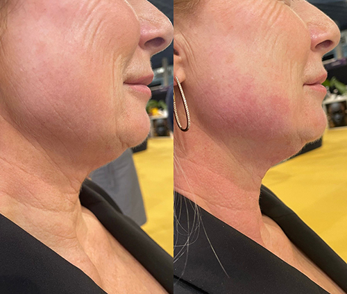 Teslamedgelaat-voorenna2