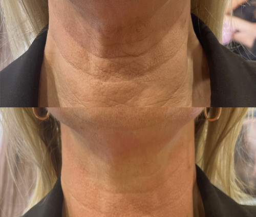 Teslamedgelaat-voorenna4